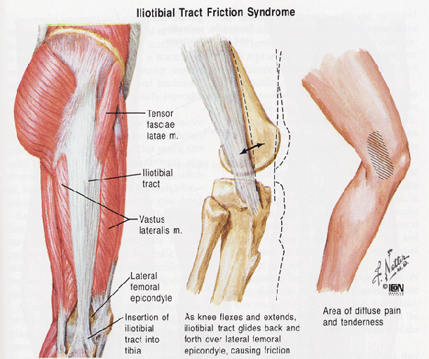  Image: Netter FH. Iliotibial band friction syndrome. Image Source: http://www.netterimages.com/image/iliotibial-band-friction-syndrome.htm