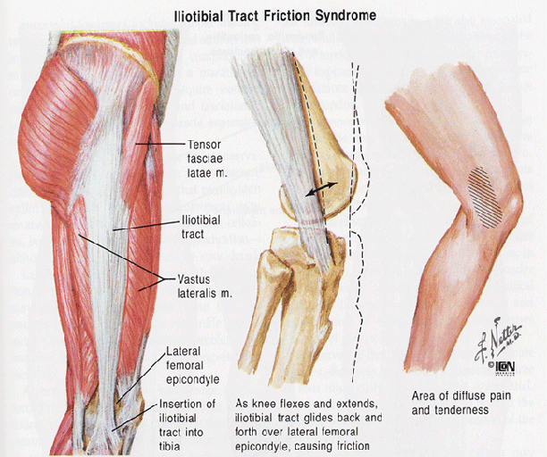 IT-Band Friction Syndrome…