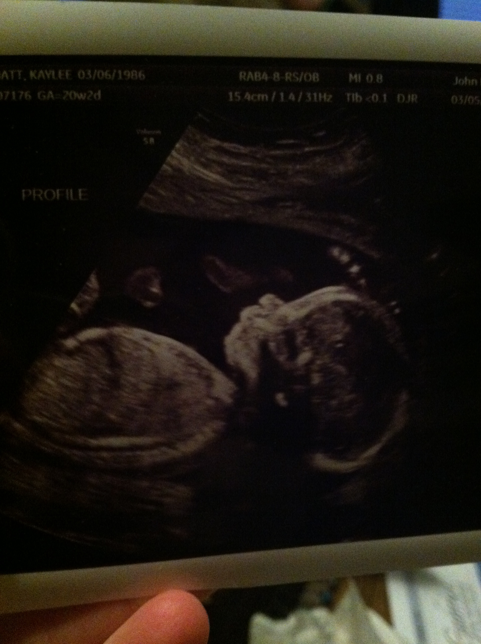 ultrasound, baby, infant, 20weeks