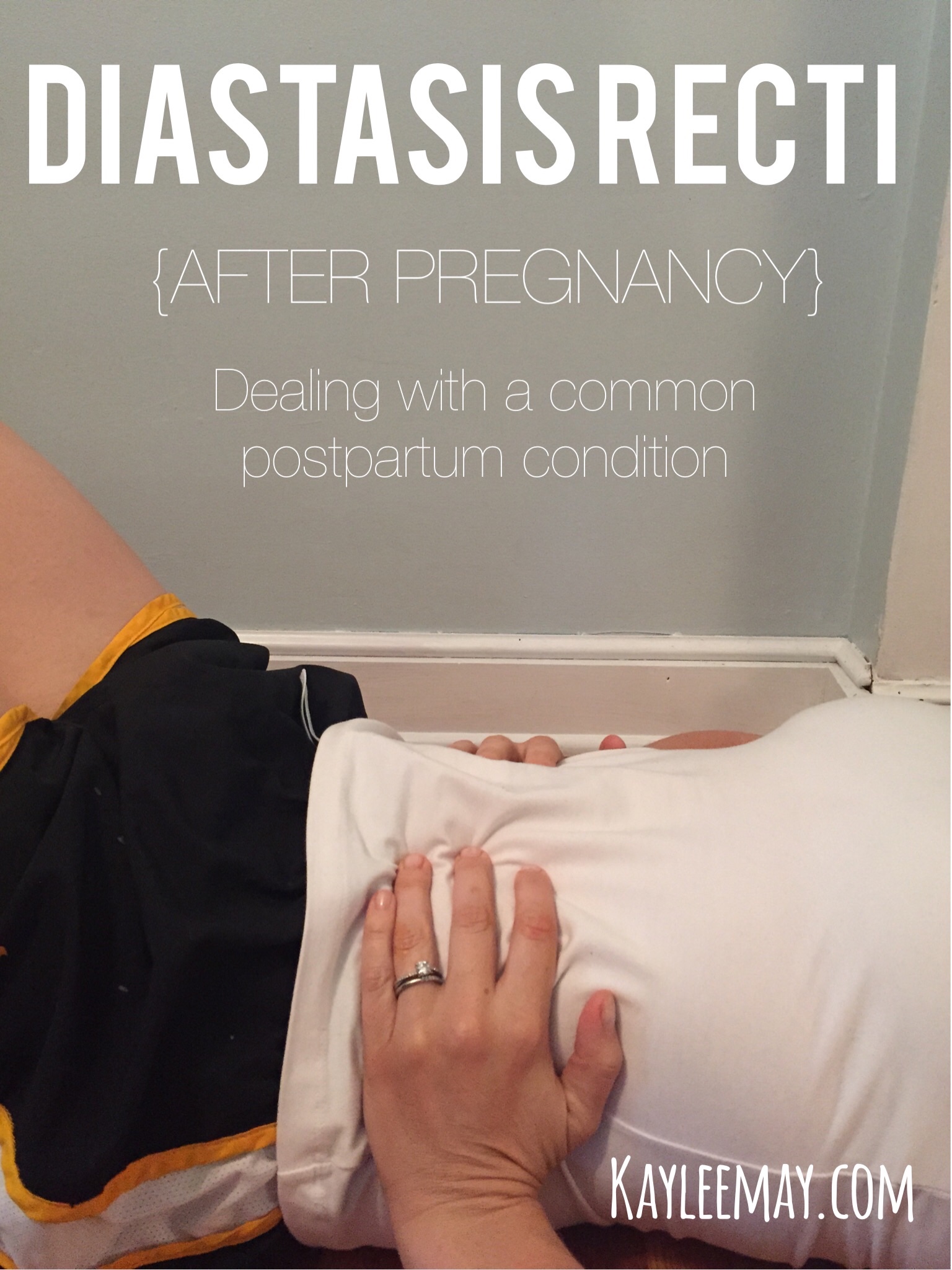 Diastasis Recti Dealing With A Common Postpartum Condition Kaylee May